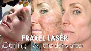 My FRACTIONAL CO2 LASER Experience  The FULL Treatment amp the DAYS following  BEFORE amp AFTER Fraxel [upl. by Philipa]