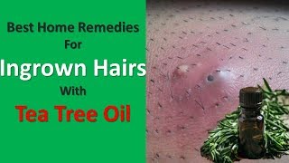 Best Home Remedies For Reducing Ingrown Hairs With Tea Tree Oil [upl. by Parent]