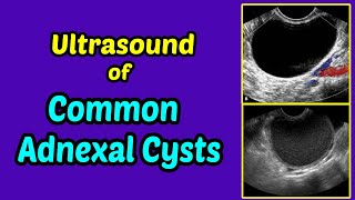 Ultrasound of Common Adnexal Cysts [upl. by Teddy]