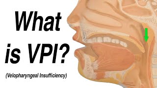 Velopharyngeal Insufficiency VPI Causing Hypernasal Speech and Nasal Regurgitation with Swallow [upl. by Anilek]