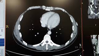 Hemangioma in liver ct [upl. by Pinzler408]