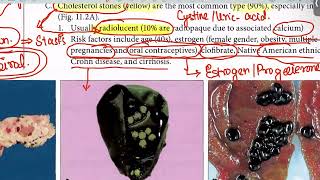 Biliary Atresia Cholelithiasis from first aid step 1USMLEUrduHindi [upl. by Lonni245]