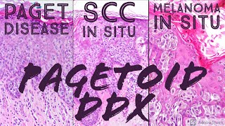 Pagetoid Differential Paget disease vs Melanoma in situ vs Squamous cell carcinoma in situ Bowen [upl. by Kore]