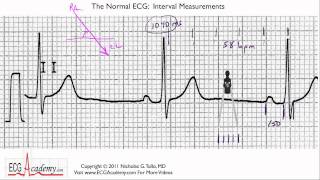 Interval Measurements 64  ECG  EKG Interpretation  BASIC [upl. by Yengac]