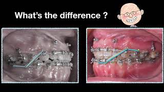 Use of Elastics and Space Generation in Midline Correction｜【Chris Chang Ortho】CC489 [upl. by Tacy]