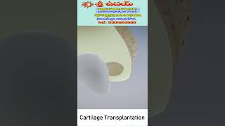 Cartilage TransplantationCartilageRegeneration CartilageTransplant JointCare JointHealth [upl. by Fiedling41]