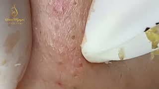 Loan Nguyen Acne Treatment 0288hn [upl. by Juley]