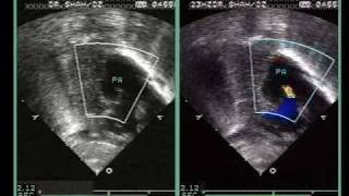 Neonatal Marfan Syndrome with Pulmonary Artery Root Dilatation [upl. by Arej265]