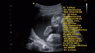 fetal ultrasound of 30 weeks baby boy moving [upl. by Aihsekal]