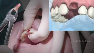 Fractured Tooth Extraction Bone Graft Implant  Dental Minute with Steven T Cutbirth DDS [upl. by Bunde]