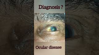 Diagnosis Ocular Eye disease [upl. by Arissa646]