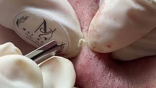 ACNE UNDER THE SKIN  Acne Treatment Mai Ngoc [upl. by Otreblanauj338]