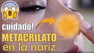 Retiro de METACRILATO de la NARIZ 👃🏼 RINOPLASTÍA 😱 Complicaciones del METACRIL 🤩 Dr ALBERTO CALVO [upl. by Teressa]