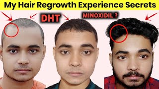 My Hair Regrowth Experience Secrets  Hair Regrowth For Men Naturally  Hair Growth in Hindi 🔥 [upl. by Oahc]