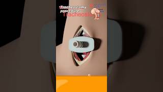 What is tracheostomy procedure 🧐 sorts [upl. by Garfinkel]