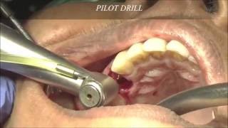 Upper premolar immediate extraction and dental implant placement [upl. by Jangro]