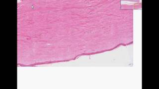 Histopathology Skin kidney Systemic sclerosis scleroderm [upl. by Ahsilrae979]