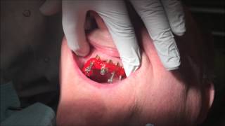 allonx allon4 StepbyStep AllonFour Dentures Part 1 Impressions [upl. by Trebreh]