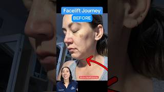 This Is A Facelift Journey BEFORE AFTER RESULTS [upl. by Beitch816]