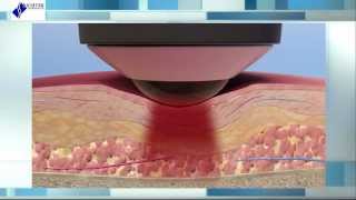 Deep Tissue Laser Therapy The Science Behind Healing [upl. by Bihas]