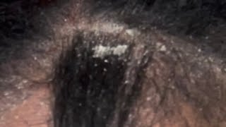 Dandruff Scratching Buildup Lots of Scaly Popping Psoriasis Flakes Itchy Scalp Flareup [upl. by Adkins]