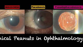 Phacodonesis Vs Iridodonesis Vs Pseudophakodonesis [upl. by Joy]