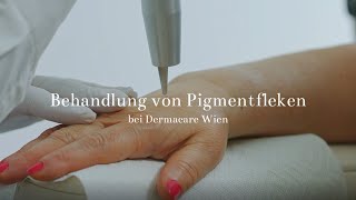 Behandlung von Pigmentflecken bei Dermacare Wien [upl. by Drofla]