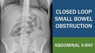 Closed Loop Small Bowel Obstruction Post Laparoscopic Rectopexy  Titanium Surgical Tacks [upl. by Nosnarb]