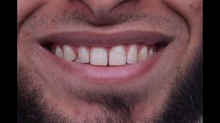 Multiple diastema closure with composite resin [upl. by Neema]