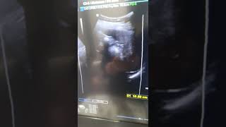 Our spleen on ultrasound imaging health youtubeshorts [upl. by Einnej713]