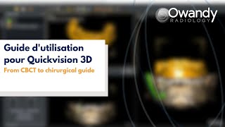 From CBCT to chirurgical guide from Owandy Radiology [upl. by Calvert67]