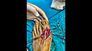 Extensor Hallucis Longus Laceration Repair [upl. by Eirahcaz781]