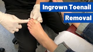 Ingrown Toenail Removal Surgery Video  Permanent Cosmetic Procedure [upl. by Donna]