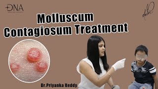 How to treat Molluscum Contagiosum  Treatment of viral skin infection  Dr Priyanka Reddy [upl. by Teeter]