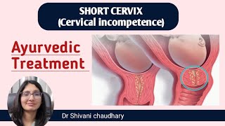 Short cervix cervical incompetence  Ayurvedic treatment ayurveda ayurvedictreatment abortion [upl. by Yendyc]