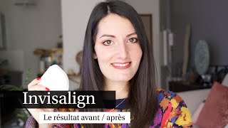 Invisalign le résultat avant  après  Rendezvous Durée fil de contention [upl. by Lenz]