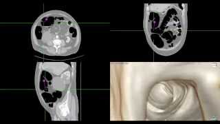 CT scan Abdominal Colonoscopy Navigated [upl. by Grantham825]