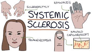 Systemic Sclerosis and Scleroderma Visual Explanation for Students [upl. by Shirleen430]