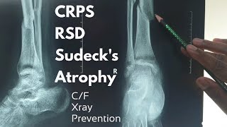 CRPSRSDSudecks AtrophyAlgodystrophy  CF amp Xray findings amp prevention  Dr Abdullah Al Rafi [upl. by Odlaumor60]