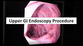 Upper GI Endoscopy Procedure in the ED [upl. by Ahsiek382]