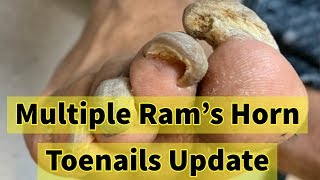 Multiple Rams Horn Toenails Update He Is Making Progress [upl. by Thia]