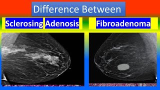 Difference Between Sclerosing Adenosis and Fibroadenoma [upl. by Pelagia]