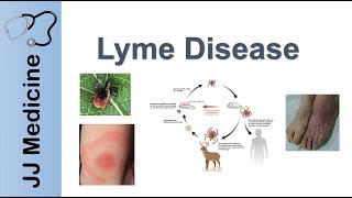 Lyme Disease  Pathophysiology Signs and Treatment [upl. by Whitcomb465]