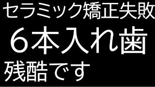 セラミック矯正の失敗で入れ歯6本 [upl. by Ecnarret]