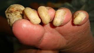 BEST FUNGAL NAIL TREATMENT How to Get Rid of Toenail Fungus Fast at Home [upl. by Abba990]