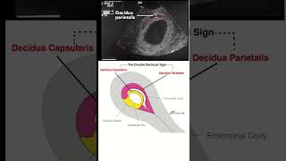 Ultrasound I Early pregnancy I double decidual sac sign DDSS [upl. by Namlas]