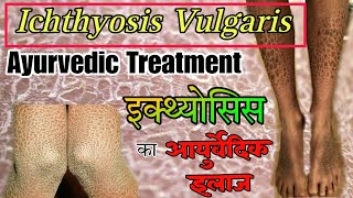 Ichthyosis Vulgaris Ayurvedic Treatment  Fish Scale Disease  Dr Mohammad Azam  इक्थ्योसिस [upl. by Mingche]