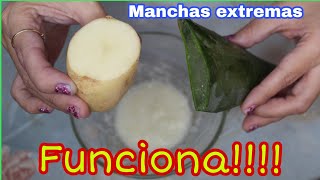 COMO QUITAR MANCHAS DE TU CARA EXTREMAS REMEDIO CASERO PARA MANCHAS [upl. by Mariand202]