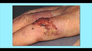 Squamous Cell Carcinoma Skin Cancer [upl. by Jacey189]