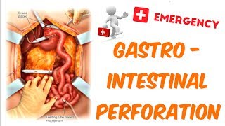 Gastrointestinal Perforation [upl. by Gaudet]